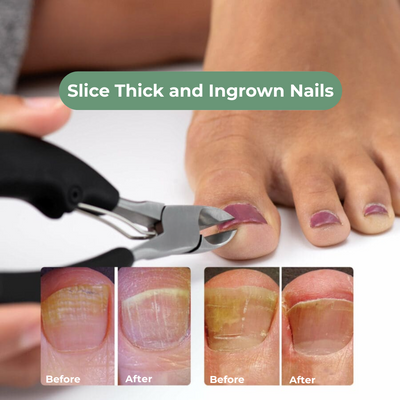 Orthopedic Nail Clipper
